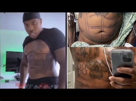 bandman kevo before and after surgery|BandMan Kevo Details Having Lipo, Says Rappers。